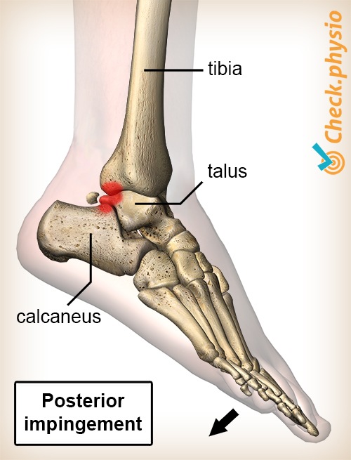 Knöchel hinteres Impingement plantare Flexion