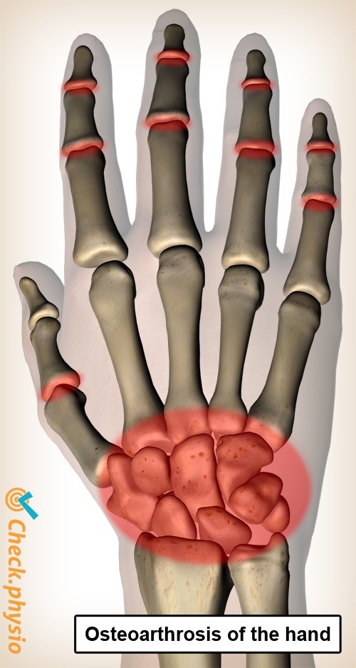 hand Arthrose Schmerzorte