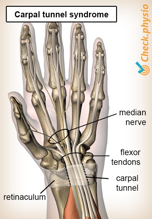 Hand Karpaltunnelsyndrom Karpale Einklemmung