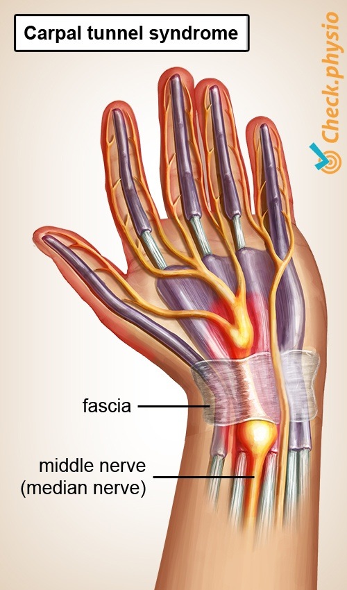 Hand Karpaltunnelsyndrom CTS Nervus medianus Einklemmung