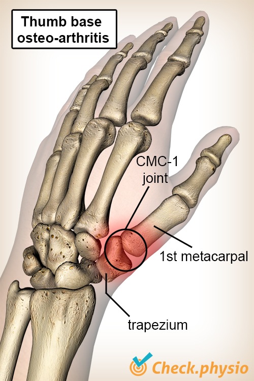 Hand Daumen Daumenbasis Arthrose Os Trapezium Mittelhandknochen Metacarpale I CMC 1 Gelenk