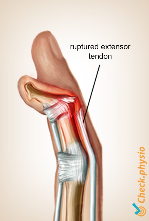 hand Hammerfinger Anatomie