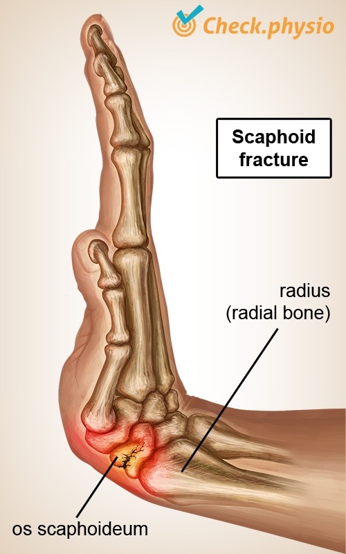 hand Kahnbeinbruch