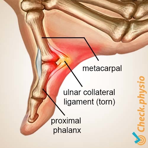 hand Skidaumen Anatomie Kollaterales Ulnarband