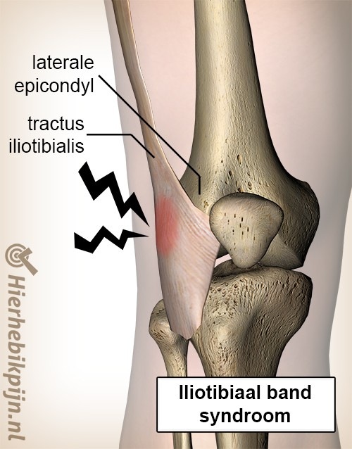 knie iliotibiales Bandsyndrom lateraler Epicondylus