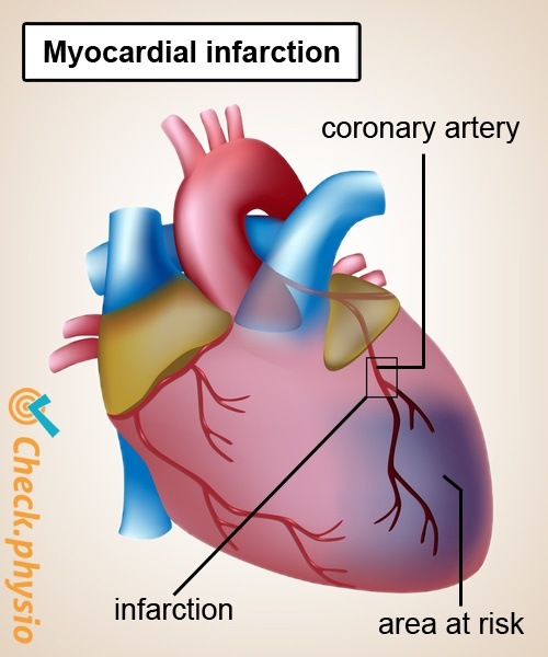 Herzinfarkt Koronararterie Anatomie