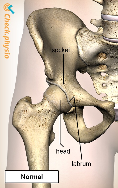 Hüfte Femoroacetabuläres Impingement FAI normal