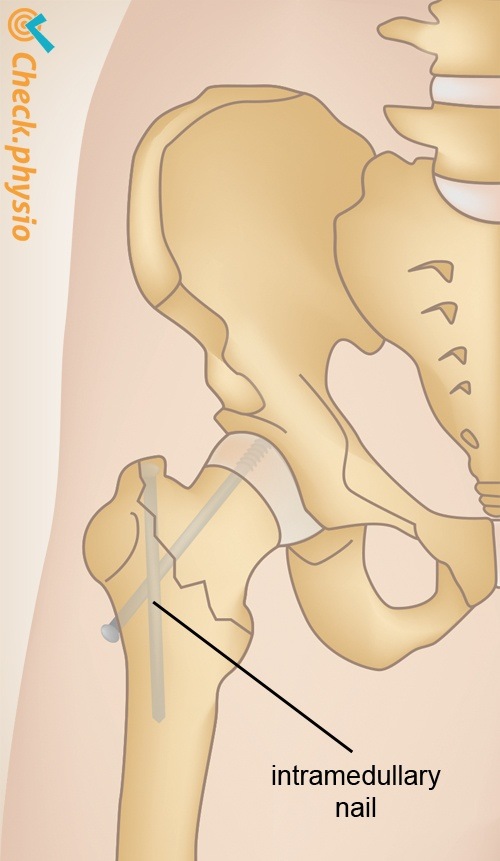 Hüfte Hüftfraktur Gammanagel