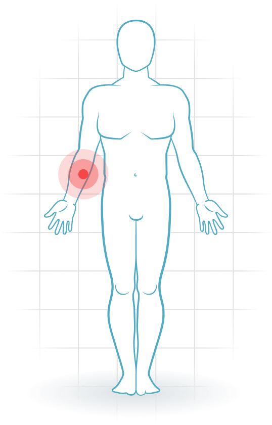 pijnlocatie Pronator-teres-Syndrom