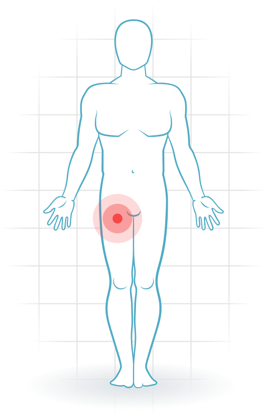 pijnlocatie Rektus-femoris-Tendinopathie