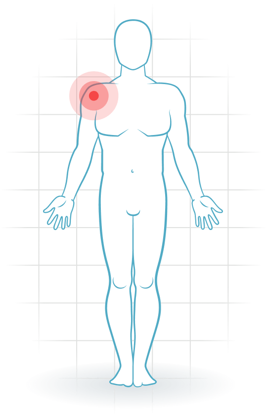 pijnlocatie Subscapularis-Tendinopathie