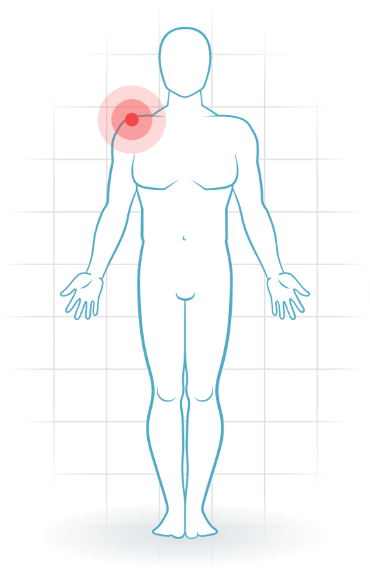 pijnlocatie Akromioklavikulares Trauma