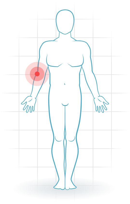pijnlocatie Tennisarm
