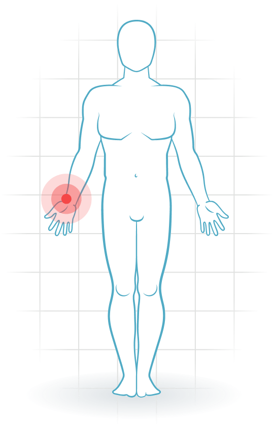 pijnlocatie Ruderer-Handgelenk