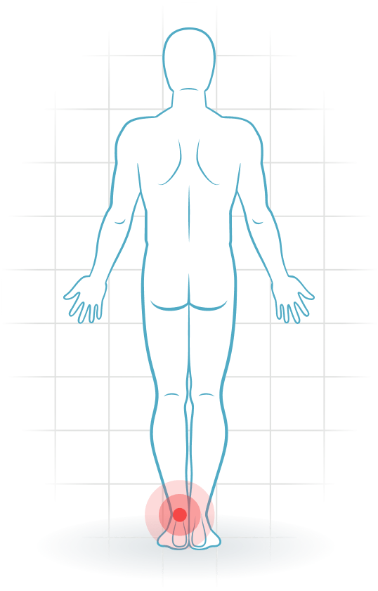 pijnlocatie Achillessehnen-Tendinopathie