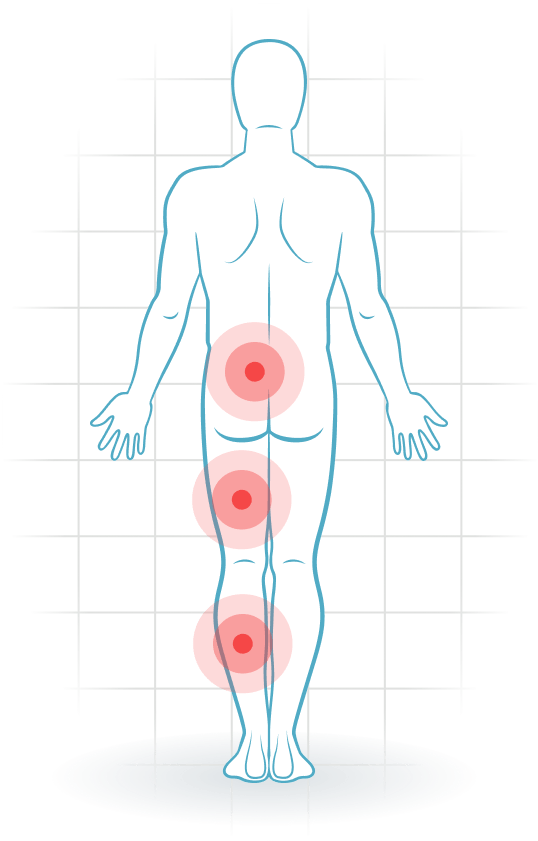 pijnlocatie Lumbale Spinalkanalstenose