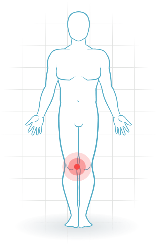 pijnlocatie Mediales Kniebandtrauma